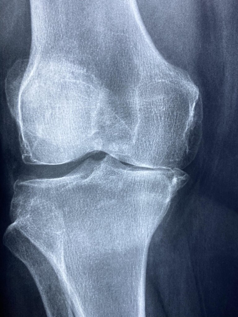 joint anatomy knee cartilage cross section